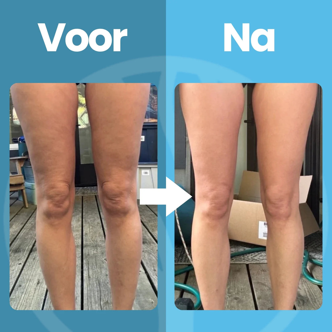 SheVitality Cellulitis Behandelaar – Eenvoudig, Veilig en Effectief